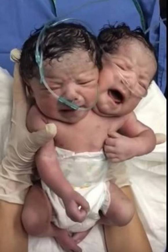Morre bebê que nasceu com duas cabeças, no México