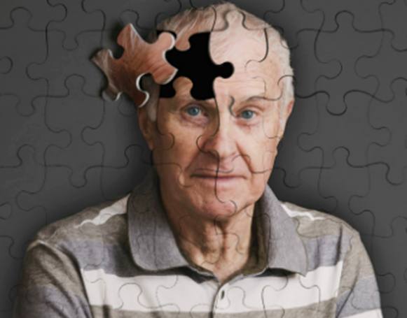 Alzheimer: teste detecta 20 anos antes